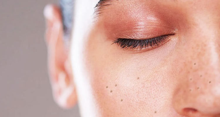 جوش‌های سر سیاه اغلب در ناحیه چهره، گردن، پشت و شانه‌ها ظاهر می‌شوند. این جوش‌ها به دلیل انسداد موی سر سیاه و ترشح چربی از پوست ایجاد می‌شوند. برای درمان جوش‌های سر سیاه و پیشگیری از آنها، می‌توانید این مراحل را دنبال کنید:   1. روزانه پوست خود را شستشو دهید: با استفاده از یک محصول تمیز کننده پوست ص ...